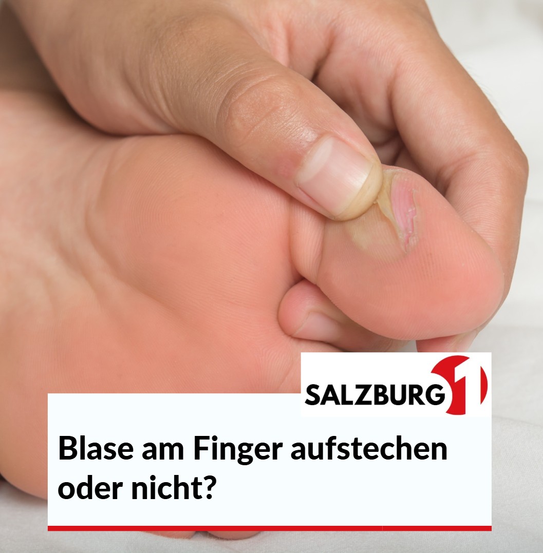 Blase am Finger aufstechen oder nicht Blase am Finger aufstechen oder nicht