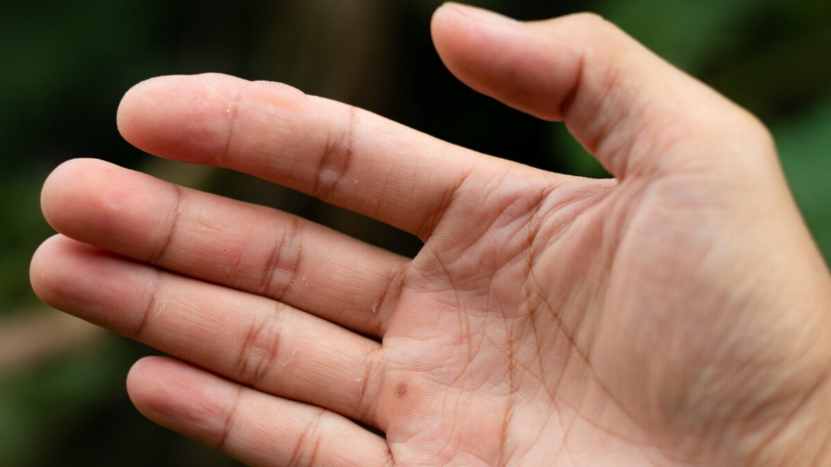 Blase am Finger - was tun Schnelle Hilfe bei Schmerzen und Druck