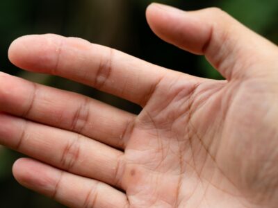 Blase am Finger - was tun Schnelle Hilfe bei Schmerzen und Druck