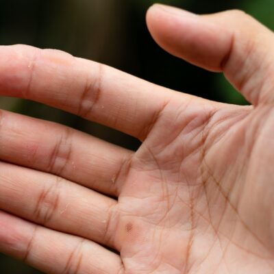 Blase am Finger - was tun Schnelle Hilfe bei Schmerzen und Druck