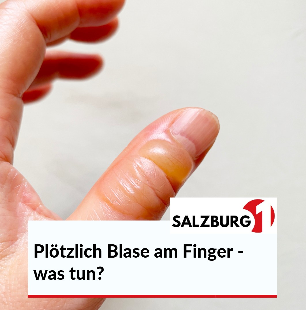 Plötzlich Blase am Finger - was tun Plötzlich Blase am Finger - was tun